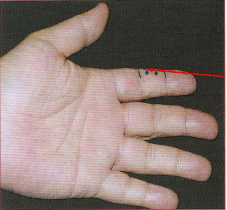 董氏奇穴-外间穴