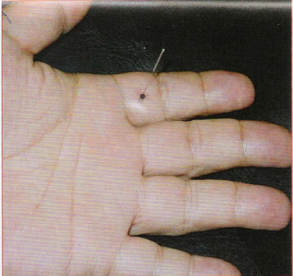 董氏奇穴-中间穴