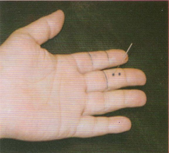 董氏奇穴-脾腫穴