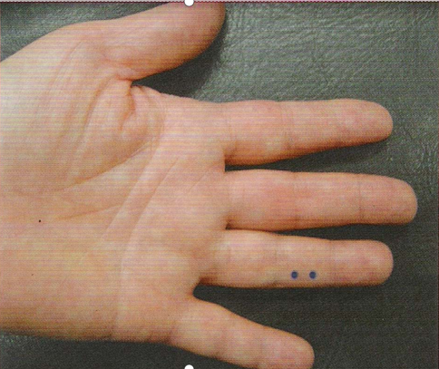 董氏奇穴-木炎穴