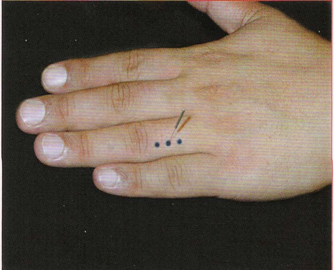 董氏奇穴-指肾穴