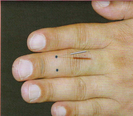 董氏奇穴-心膝穴