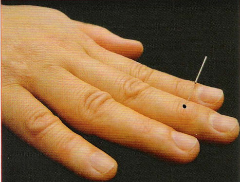 董氏奇穴-木火穴