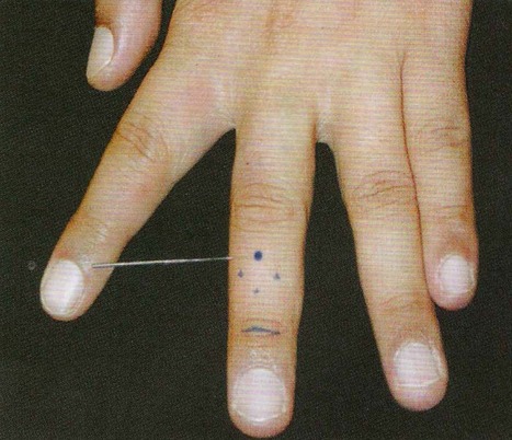 董氏奇穴-肺心穴